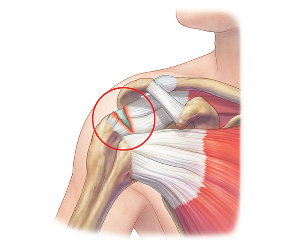 회전근개파열 비법 안양 좋은병원 회전근개파열 비법 안양 좋은병원