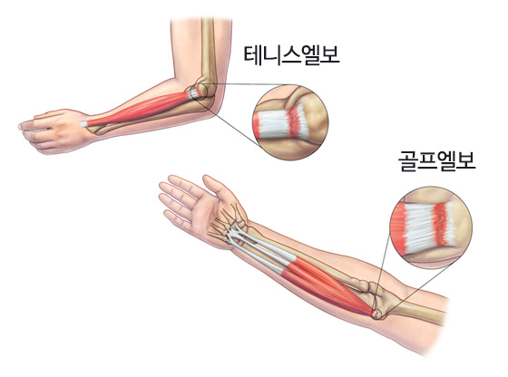 팔꿈치 안쪽에 통증이 나타나면 골프 엘보우 의심