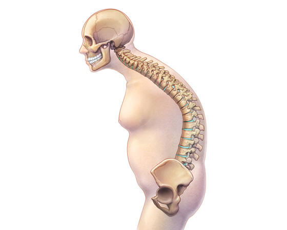 허리가 휜 경우 수술을 피하기 위해 빠른 치료가 필요합니다! 12